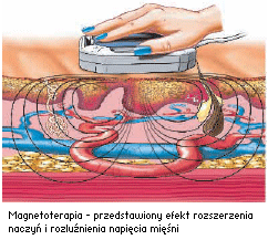 Magnetoterapia