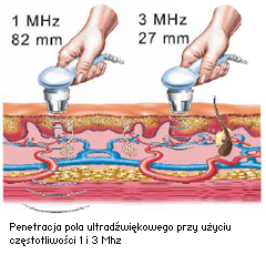 Terapia ultradźwiękowa