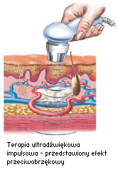 Terapia ultradźwiękowa