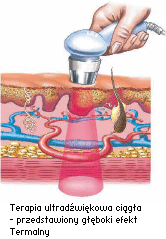 Terapia ultradźwiękowa